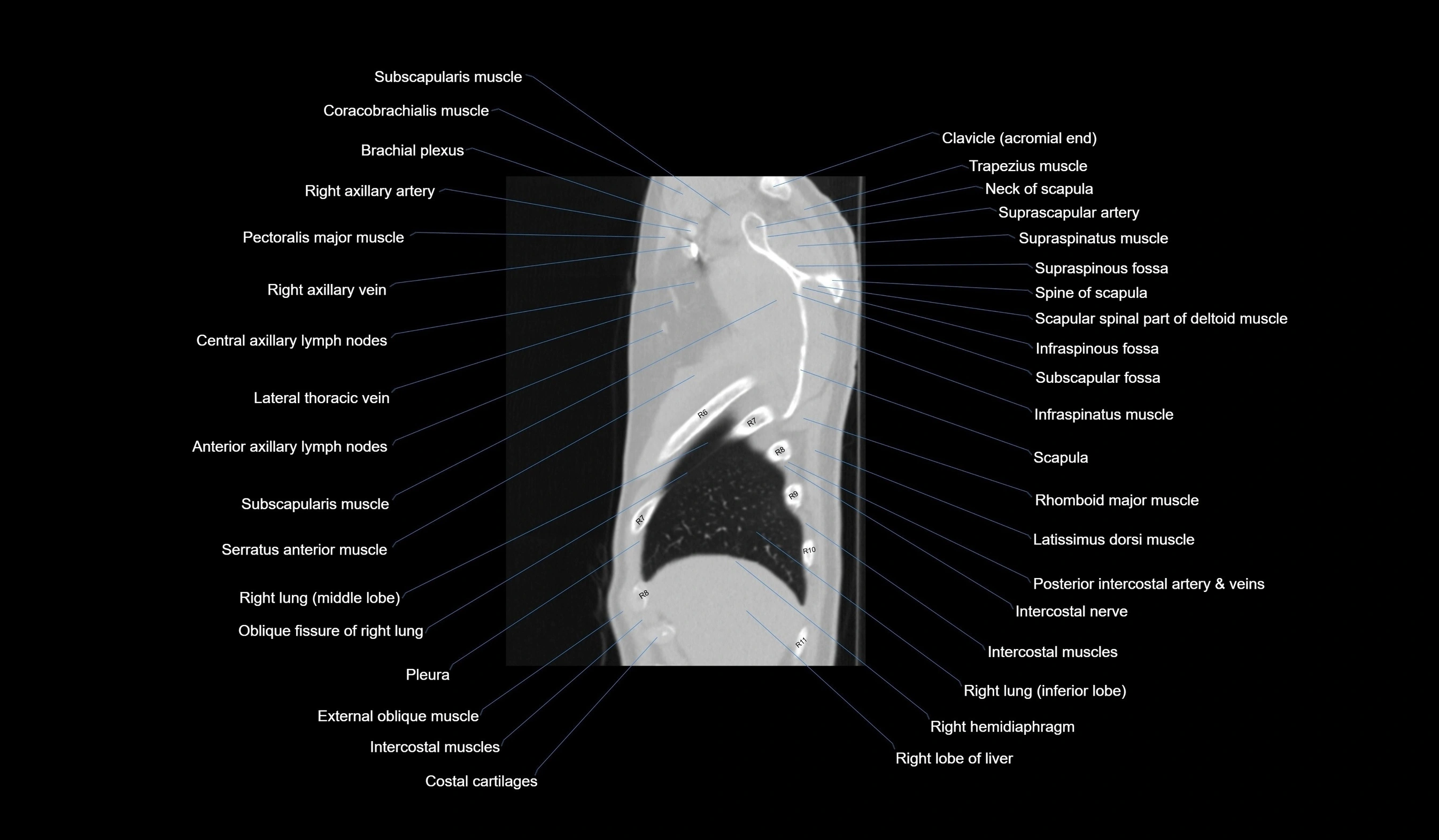 CT chest (thorax) lung window labelled sagittal cross sectional anatomy radiology image-00020.webp